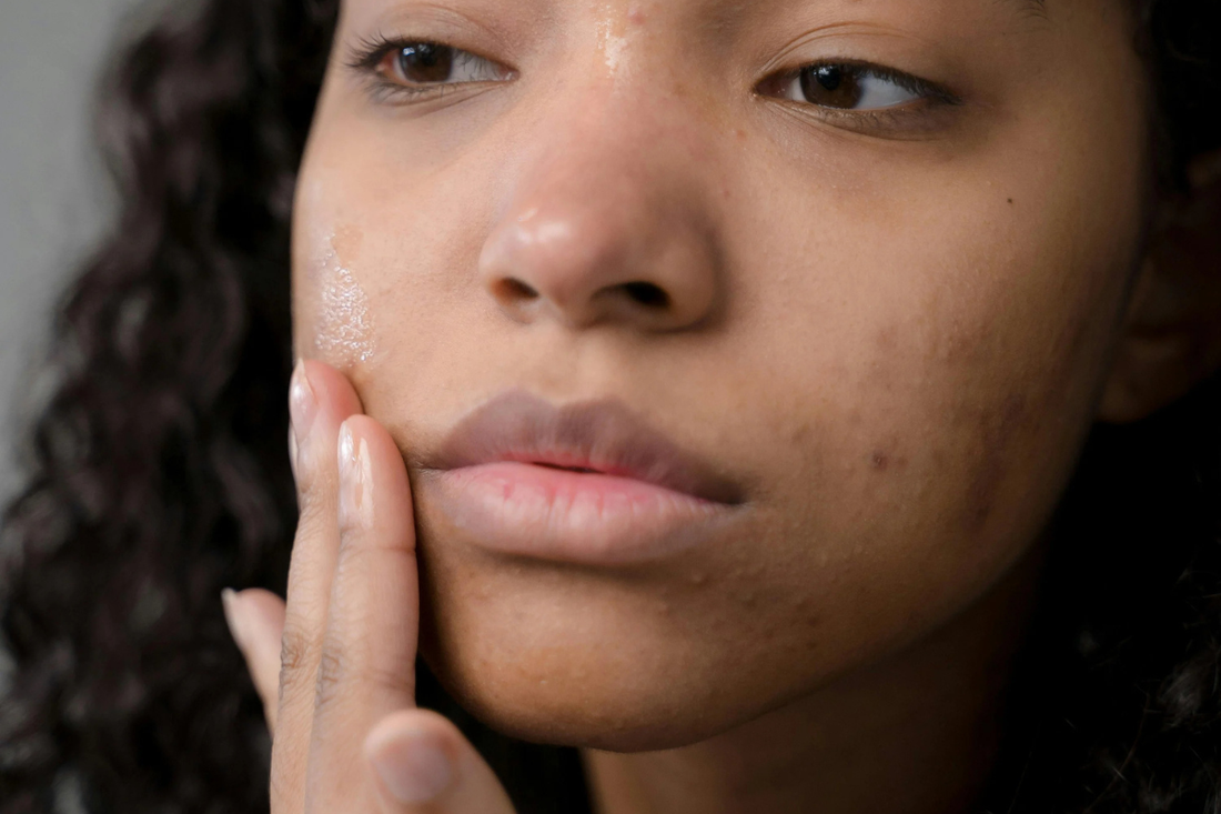 So… Do Pimple Patches Actually Work?