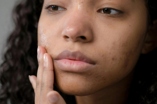 So… Do Pimple Patches Actually Work?