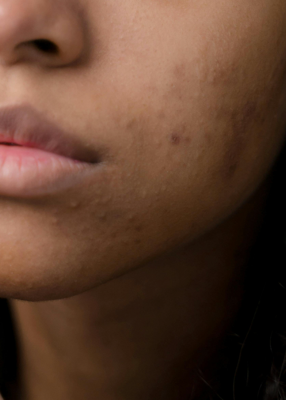 Hormonal Acne